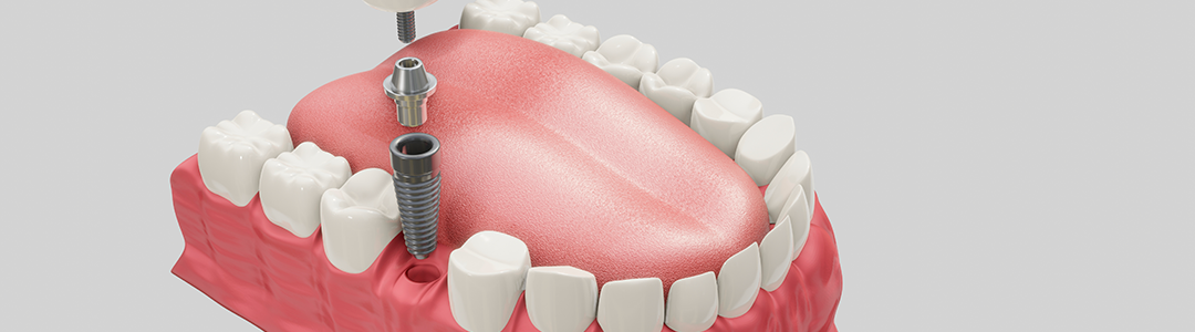 Banner Implante Dentário